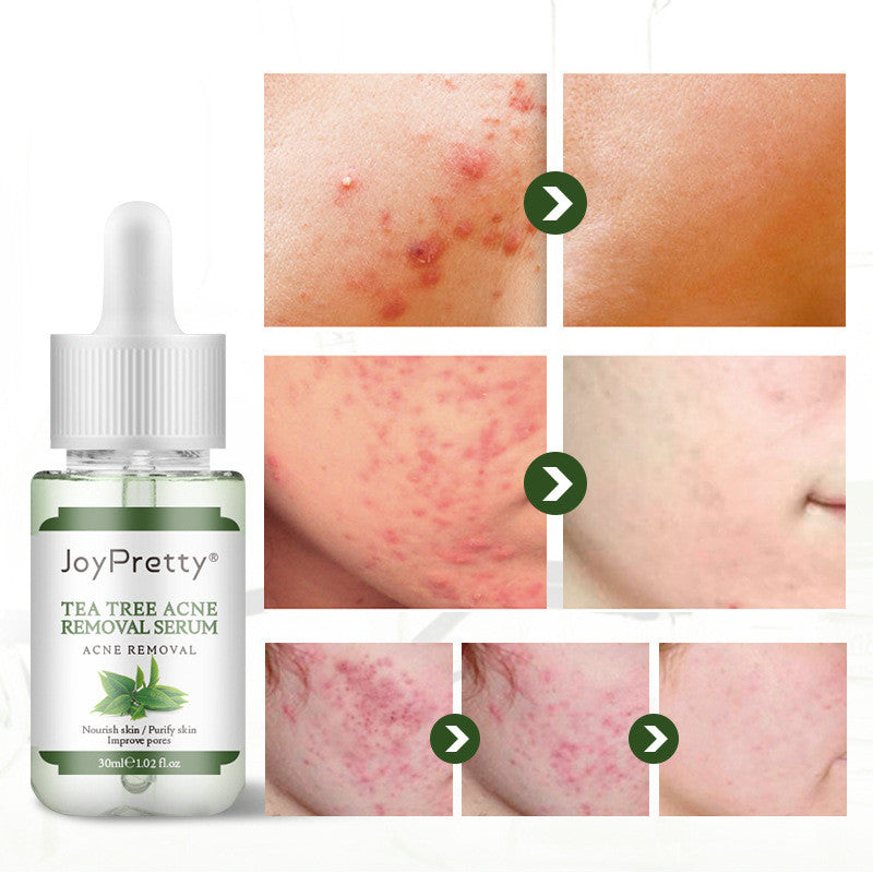 Joy Pretty, tree serum for acne treatment